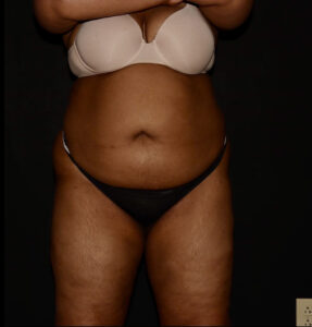 Before Image: Abdomen/Flanks