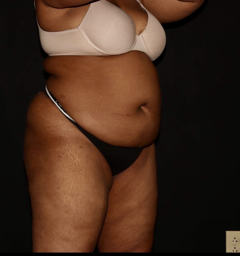 Before Image: Abdomen/Flanks - right-front-oblique