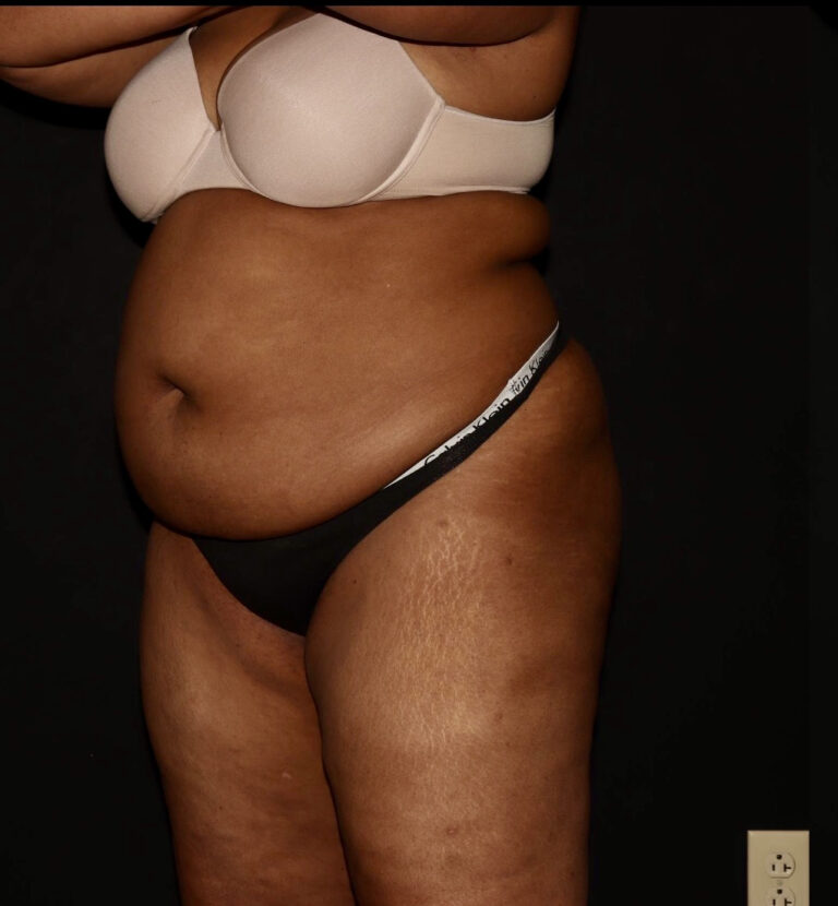 Before Image: Abdomen/Flanks - left-front-oblique