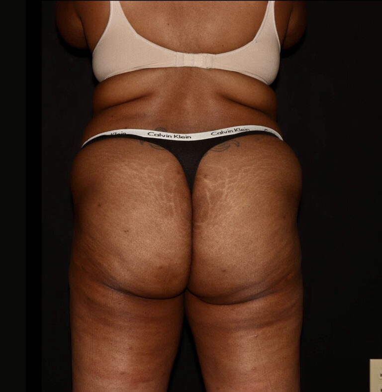 Before Image: Abdomen/Flanks - back