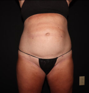 After Image: Abdomen/Flanks