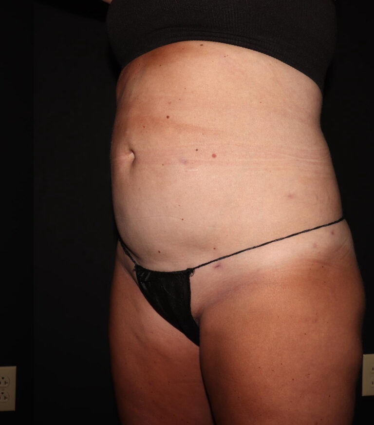 After Image: Abdomen/Flanks - left-front-oblique