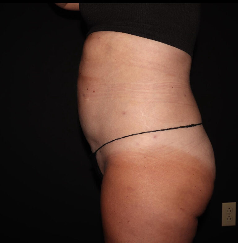 After Image: Abdomen/Flanks - left-side