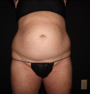 Before Image: Abdomen/Flanks