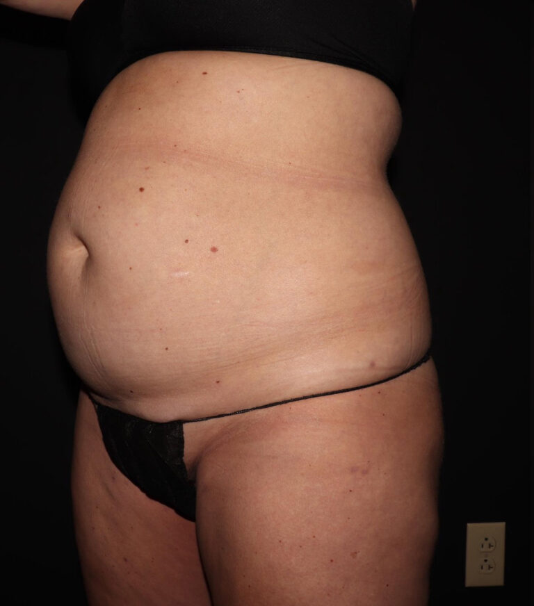 Before Image: Abdomen/Flanks - left-front-oblique