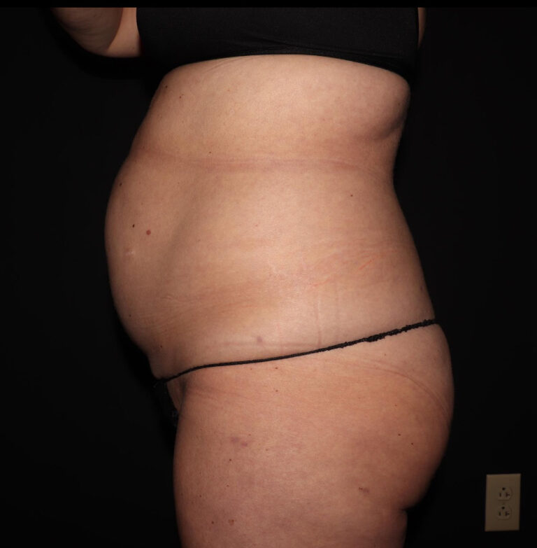 Before Image: Abdomen/Flanks - left-side