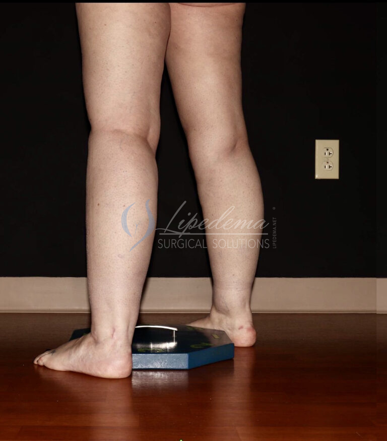 Before Image: Calves - left-back-oblique