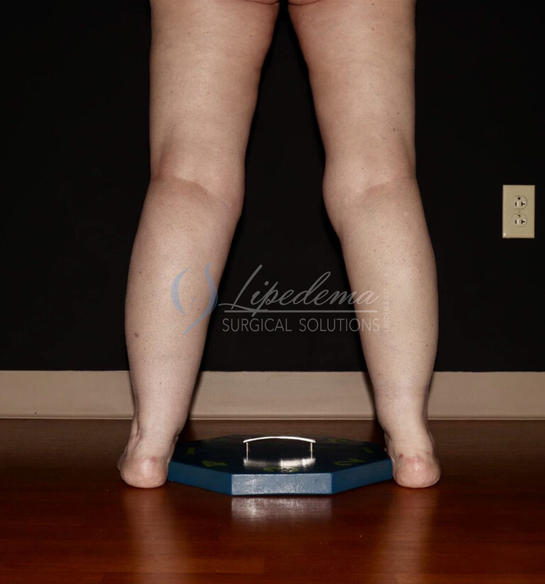 Before Image: Calves - back