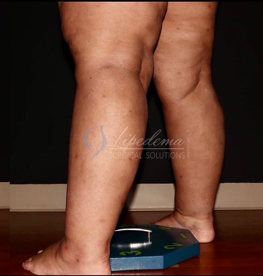 After Image: Calves - left-back-oblique