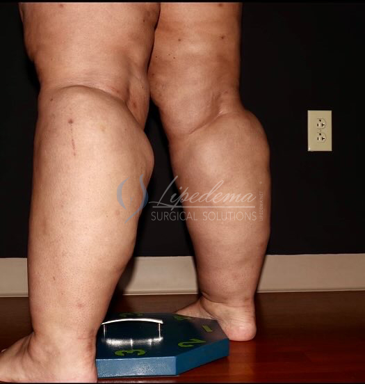 Before Image: Calves - left-back-oblique
