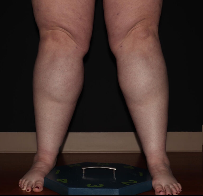 Before Image: Calves - front