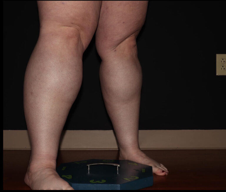 Before Image: Calves - right-front-oblique