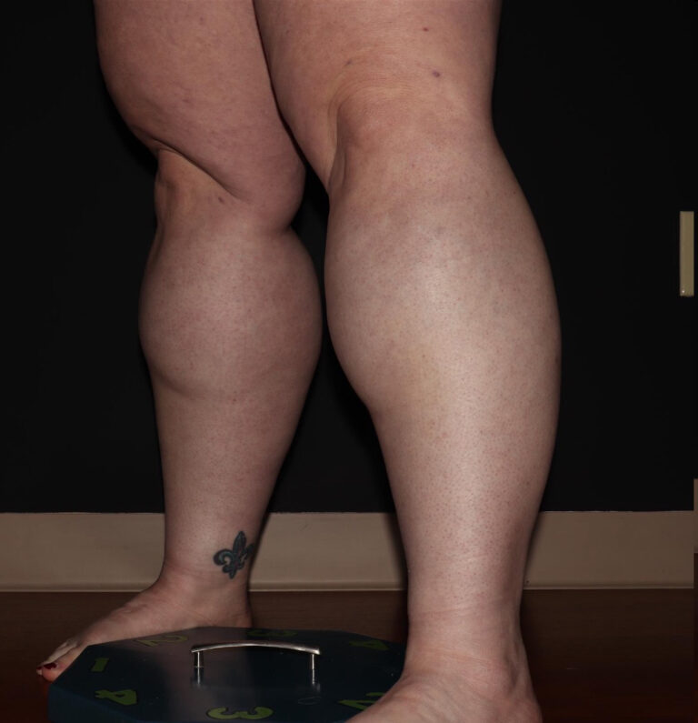 Before Image: Calves - left-front-oblique