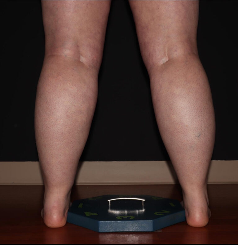 Before Image: Calves - back