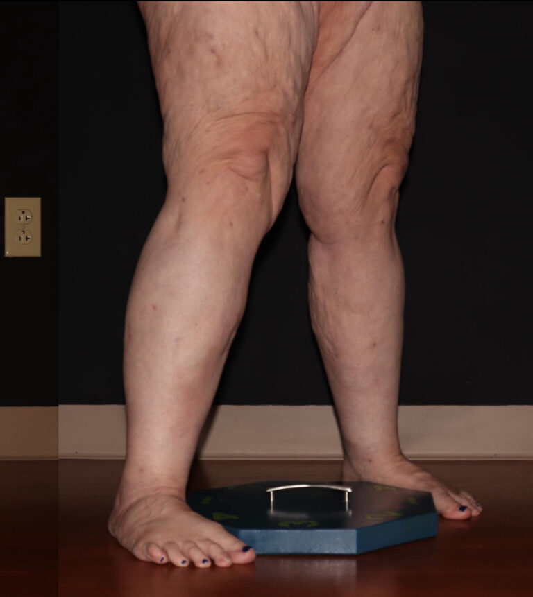 After Image: Calves - right-front-oblique
