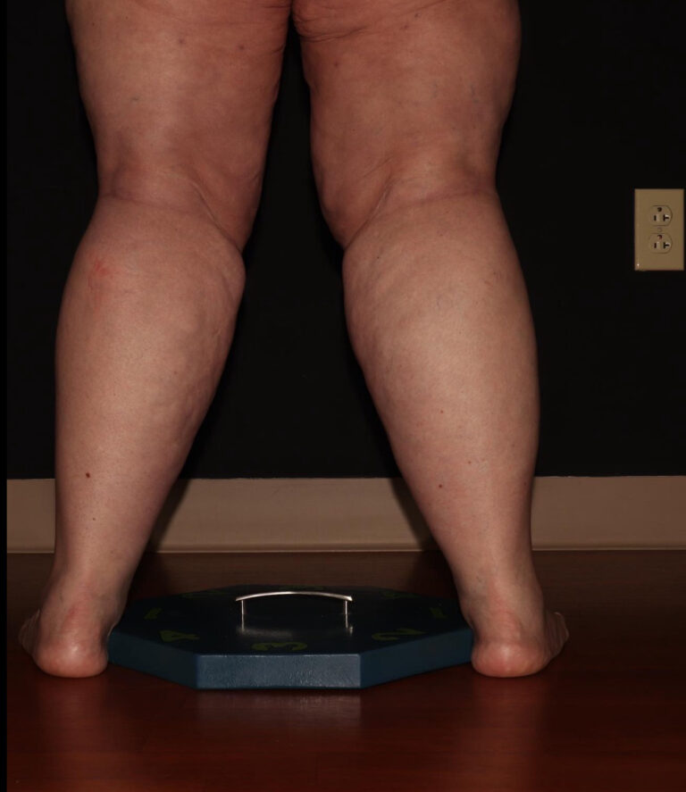 Before Image: Calves - back