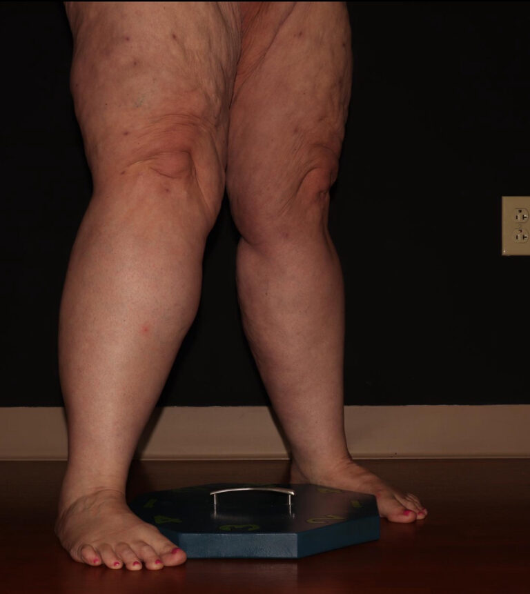 Before Image: Calves - right-front-oblique