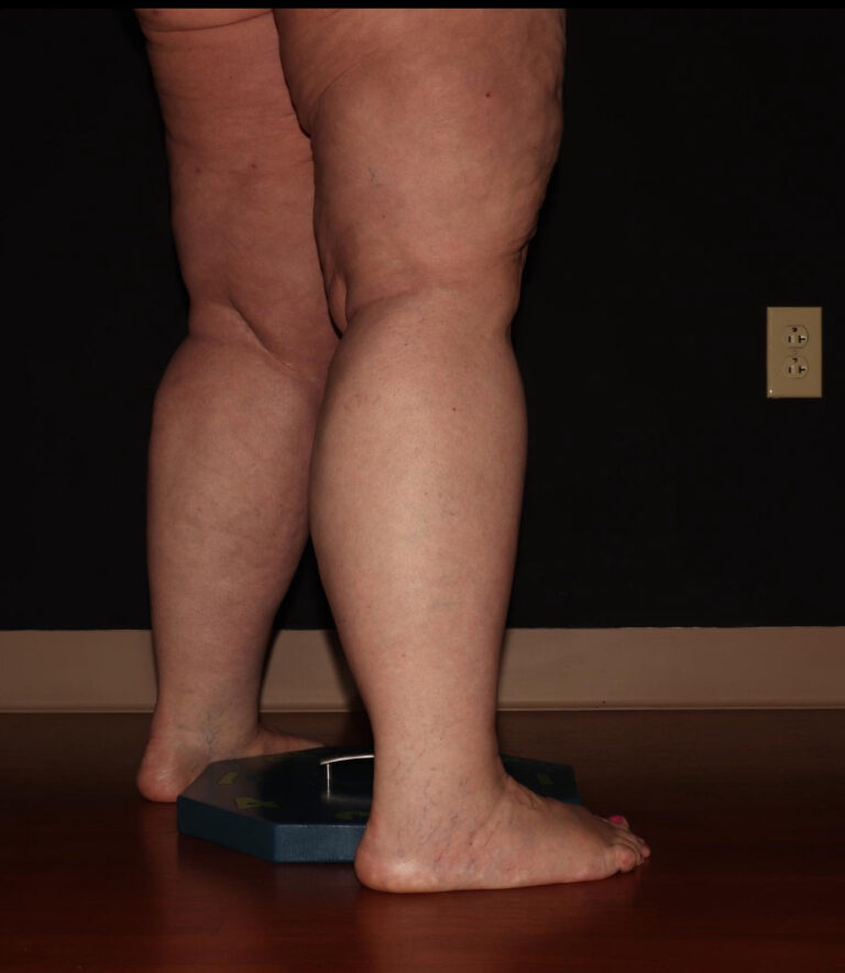 Before Image: Calves - right-back-oblique
