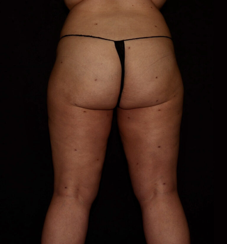 After Image: Hips and Buttocks - back