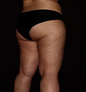 Before Image: Hips and Buttocks