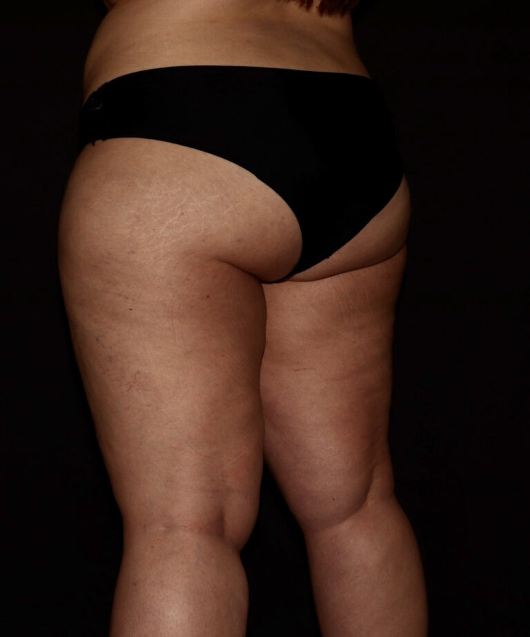 Before Image: Hips and Buttocks - left-back-oblique