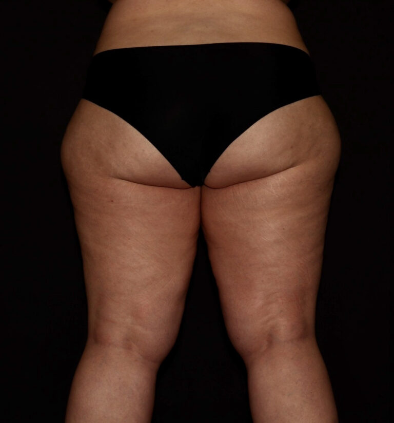 Before Image: Hips and Buttocks - back