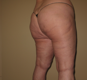 After Image: Hips and Buttocks