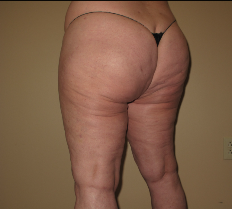 After Image: Hips and Buttocks - left-back-oblique