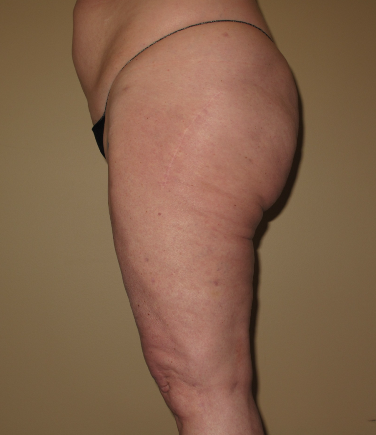 After Image: Hips and Buttocks - left-side