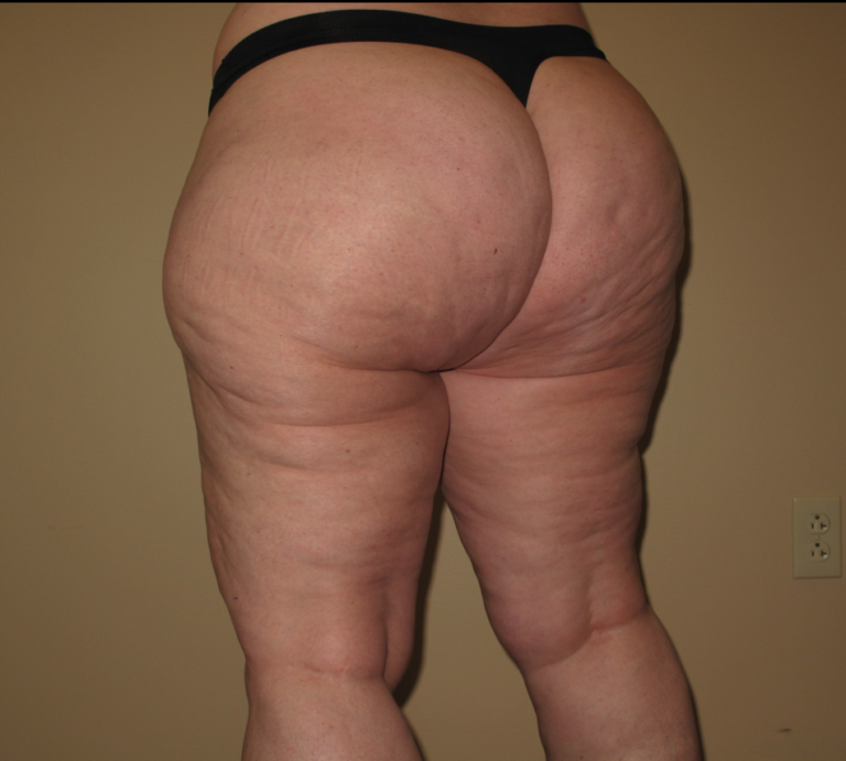 Before Image: Hips and Buttocks - left-back-oblique