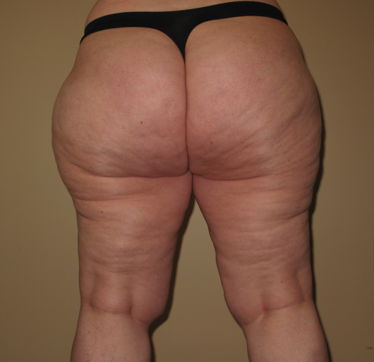 Before Image: Hips and Buttocks - back