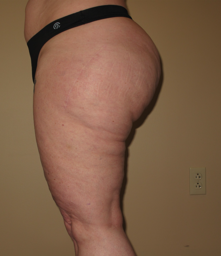 Before Image: Hips and Buttocks - left-side