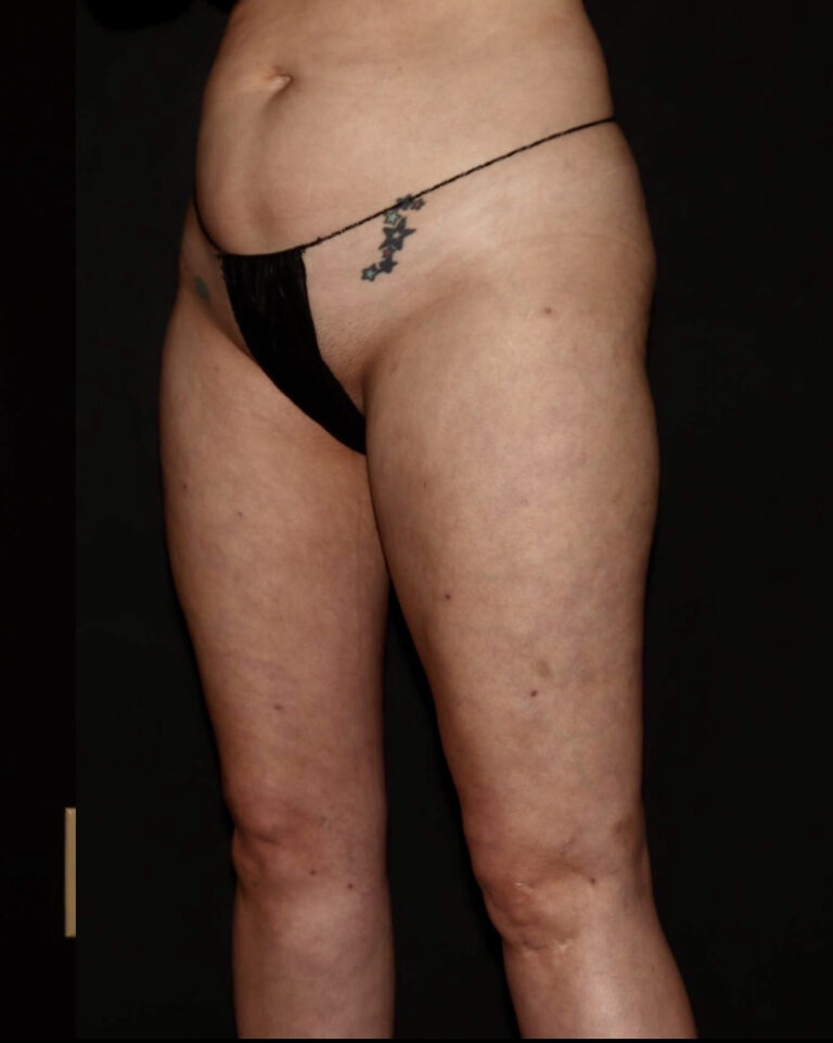 After Image: Thighs - left-front-oblique