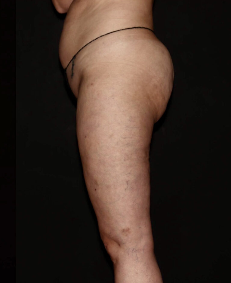 After Image: Thighs - left-side