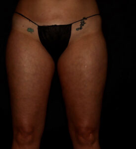 Before Image: Thighs