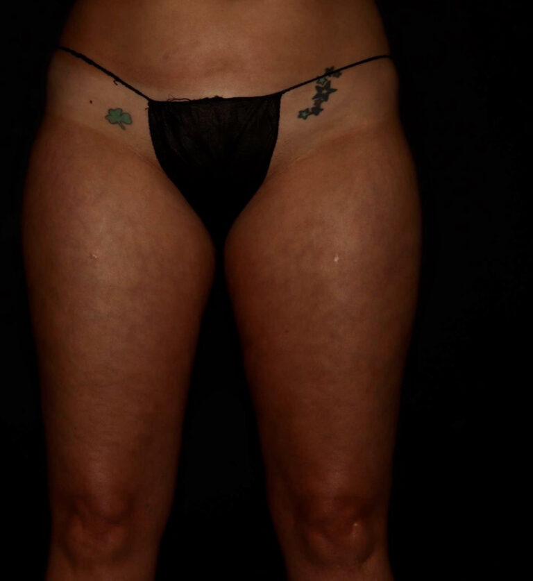 Before Image: Thighs - front