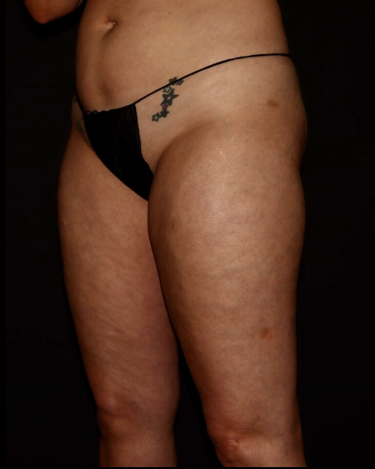 Before Image: Thighs - left-front-oblique