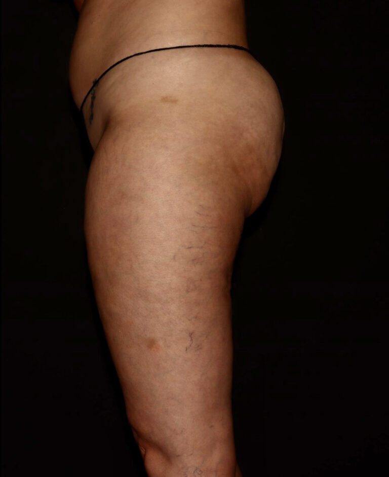 Before Image: Thighs - left-side