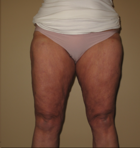 After Image: Thighs