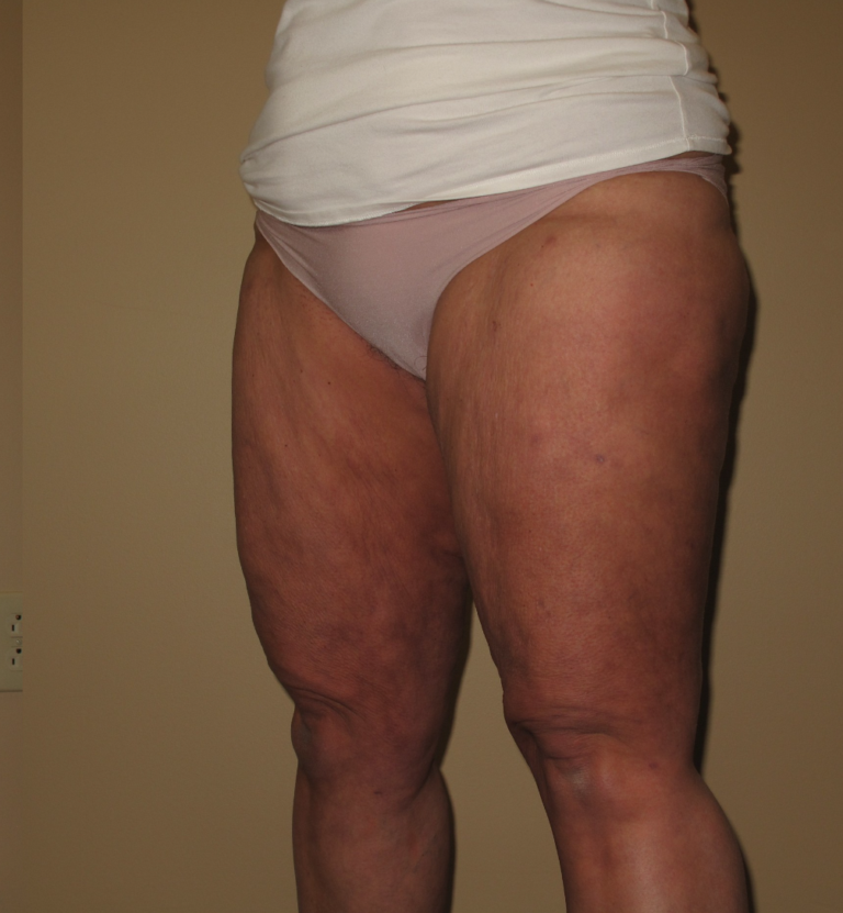 After Image: Thighs - left-front-oblique