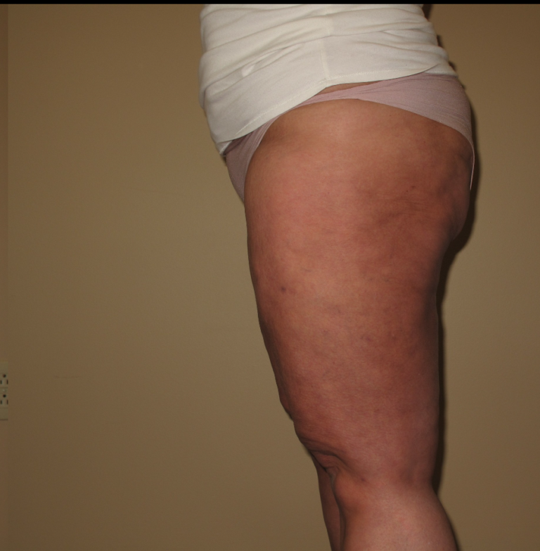 After Image: Thighs - left-side