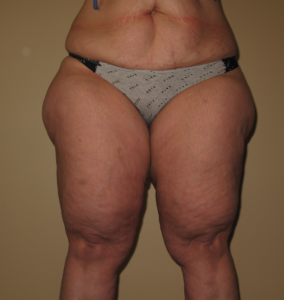Before Image: Thighs