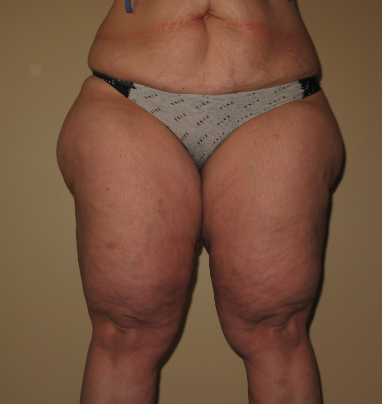 Before Image: Thighs - front