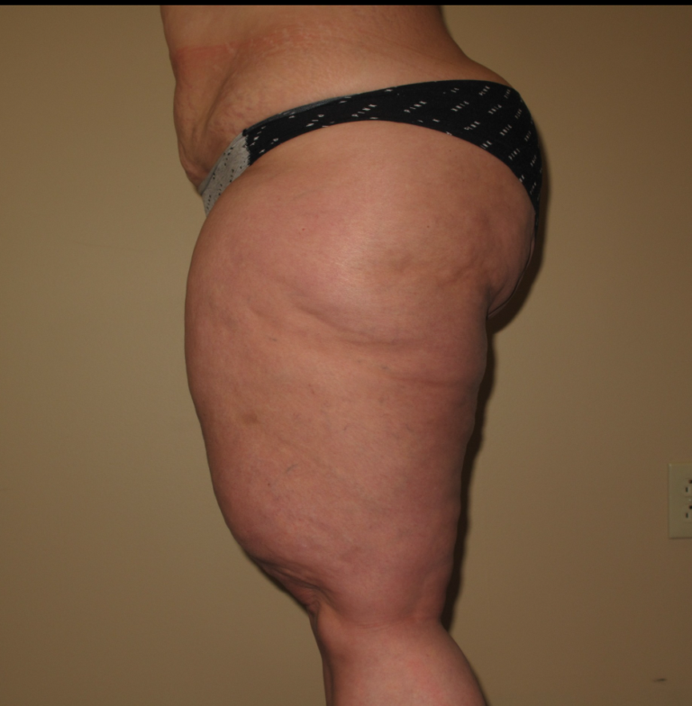 Before Image: Thighs - left-side