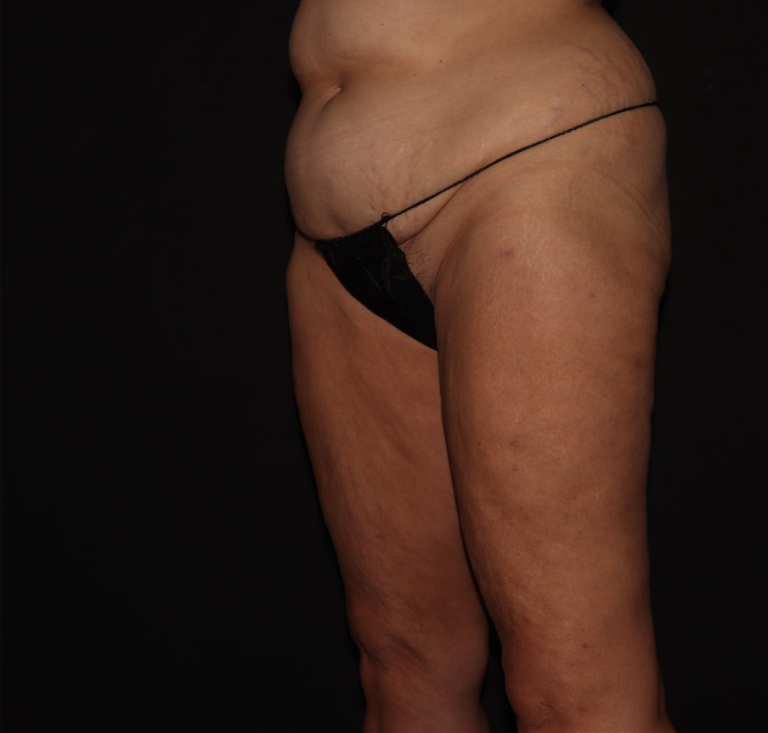 After Image: Thighs - left-front-oblique