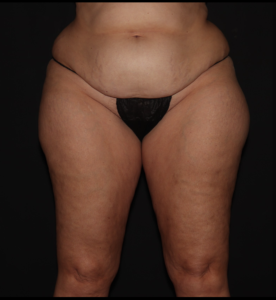 Before Image: Thighs