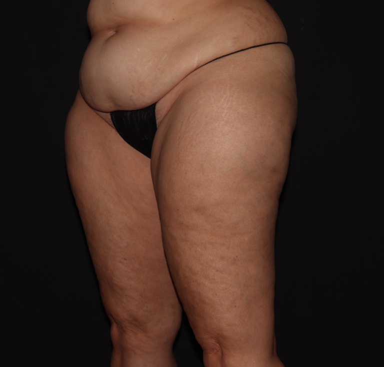 Before Image: Thighs - left-front-oblique