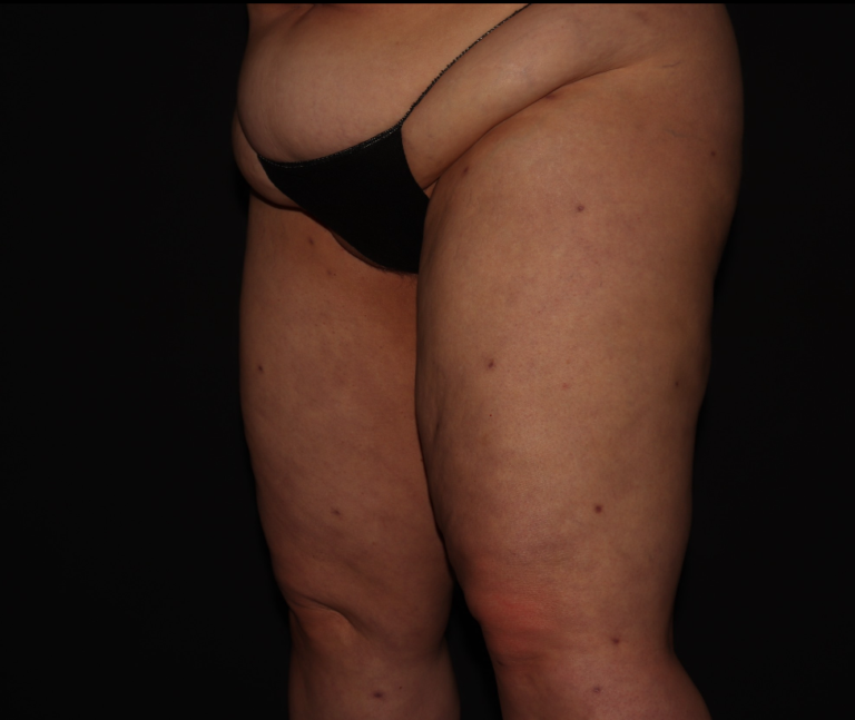 After Image: Thighs - left-front-oblique