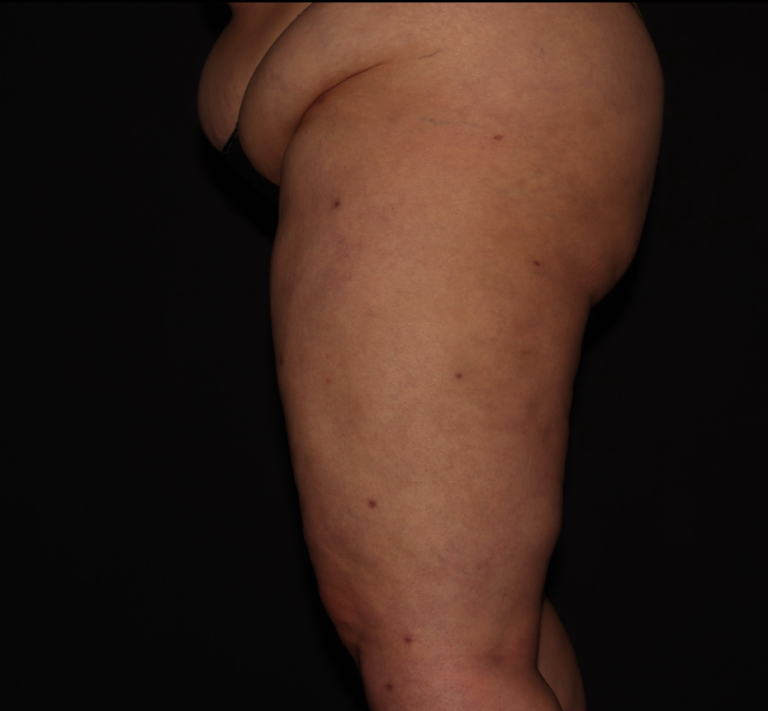 After Image: Thighs - left-side