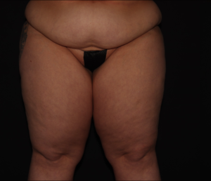 Before Image: Thighs